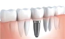 تولید بخش‌های مختلف ایمپلنت دندانی و ساخت مواد استخوانی برای بازسازی بافت های سخت