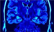 کشف جدید مغزی راز تقویت توانایی مبارزه با آلزایمر و ام‌اس را برملا کرد