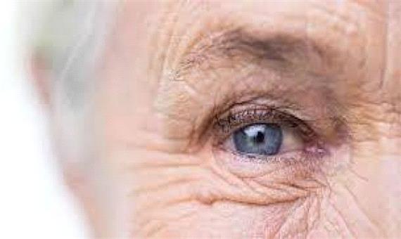 استرس مکرر باعث پیر چشمی می‌شود