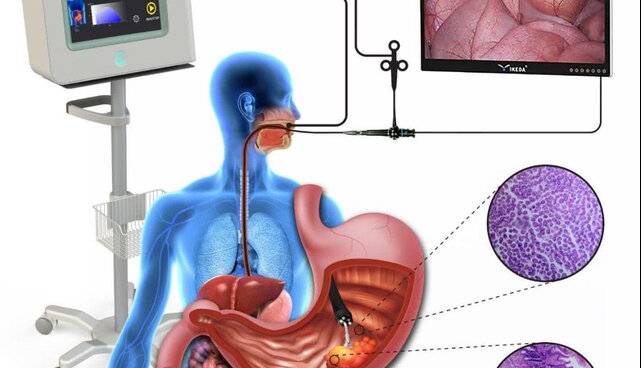 ساخت دستگاه تشخیص دقیق سرطان‌های دستگاه گوارش فوقانی