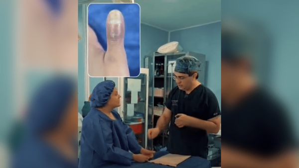 کاشت ناخن و احتمال قطع انگشت