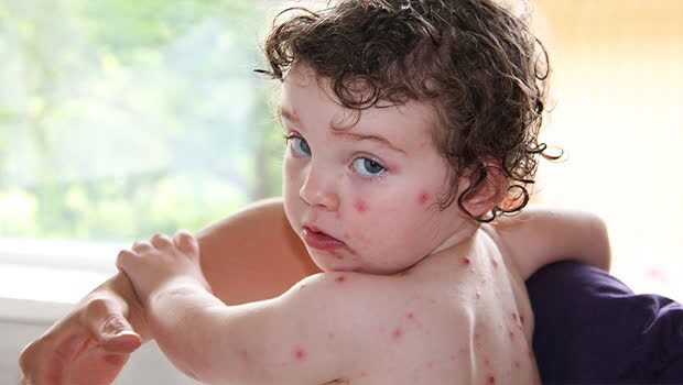 آبله مرغان، بیماری‌ای که در زمستان و بهار بیشتر دیده می‌شود