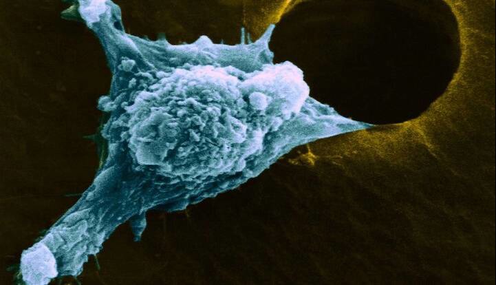 نانوذراتی که سرطان را غافلگیر کردند؛ بیدارباش سیستم ایمنی علیه ملانوما