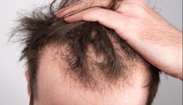 ماینوکسیدیل خوراکی برای ریزش موی مردانه موثرتر است